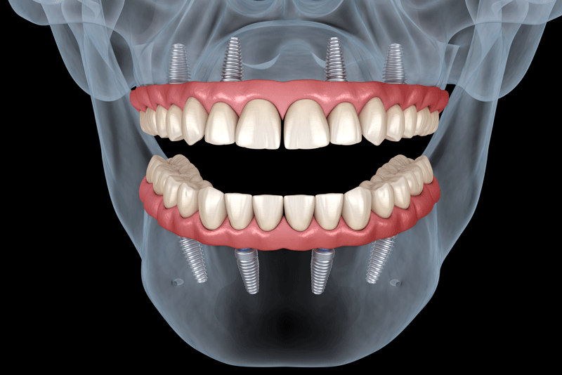 An image of full mouth dental implants on a 3D facial model.