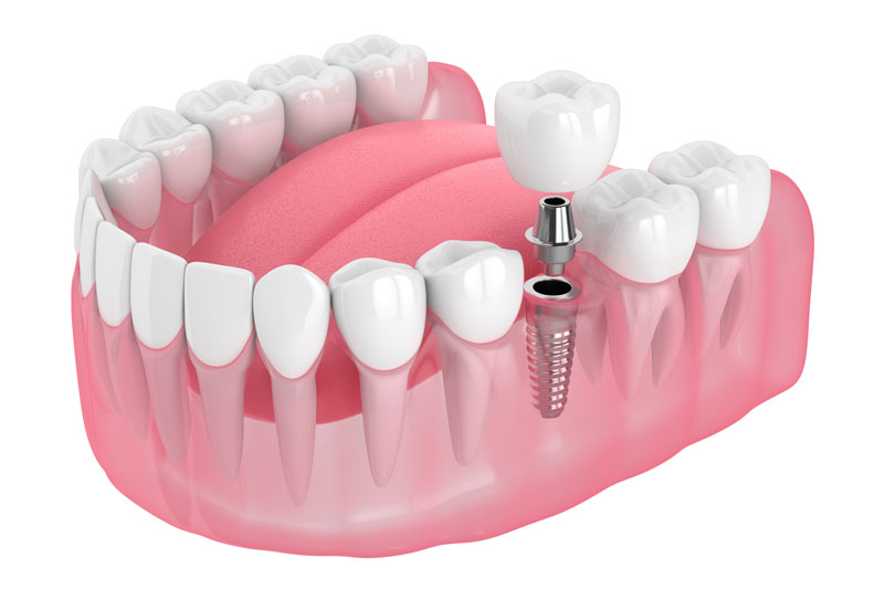 a single dental implant with a crown and an abutment floating above the implant