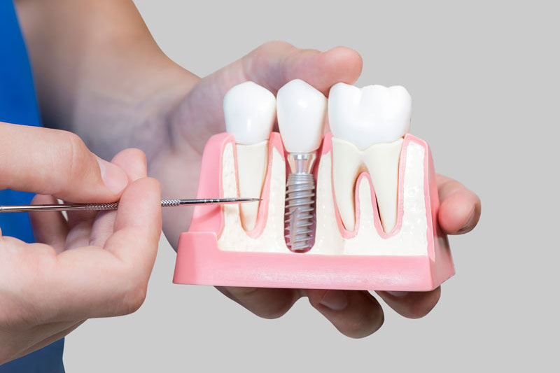 a dental implant model with a crown on top near the molars