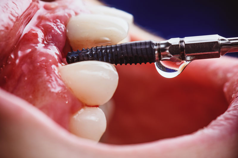 a single dental implant with a drill placing it into the mouth