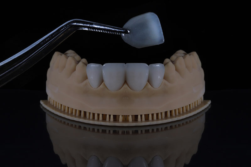 a dental veneer being held by tongs with a full jaw piece holding more