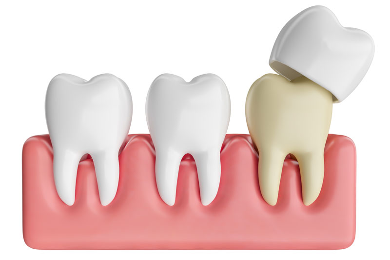 a crown being placed on a damaged tooth