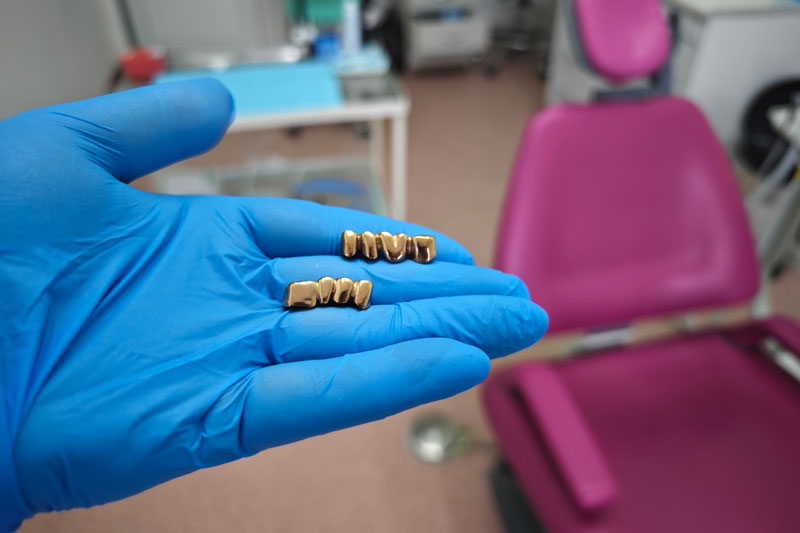 A yellow gold crown is delivered on a stone model and die, ready to be cemented in the mouth.