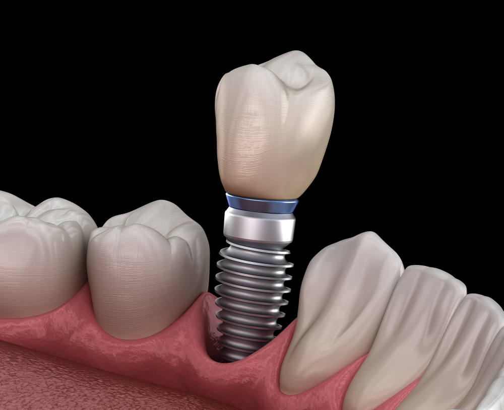3D illustration of a single dental implant with crown placement in the lower jaw, showing integration with surrounding teeth and gums."